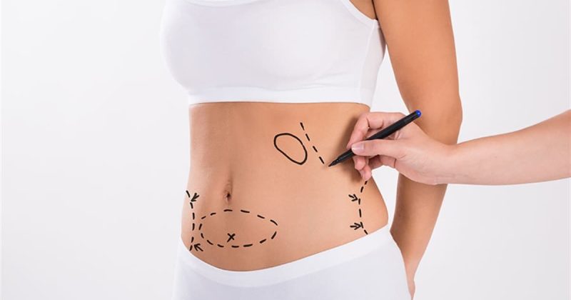Liposuction